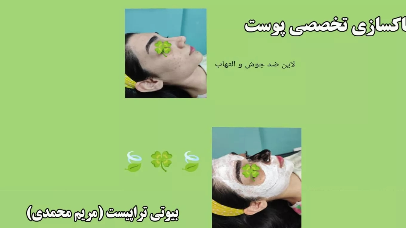 بیوتی تراپیست مریم اسکین کر و پاکسازی صورت در رشت