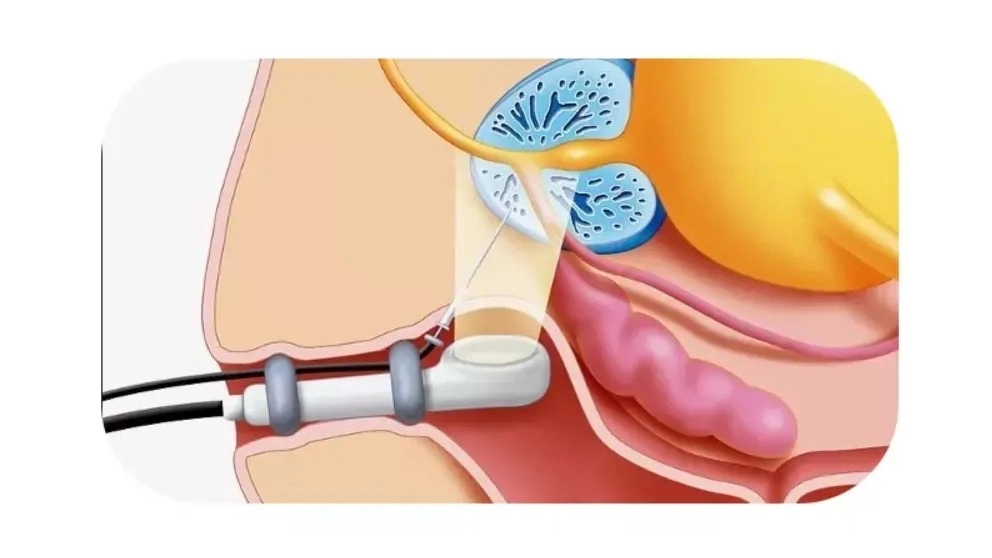 Transrektal ultrason