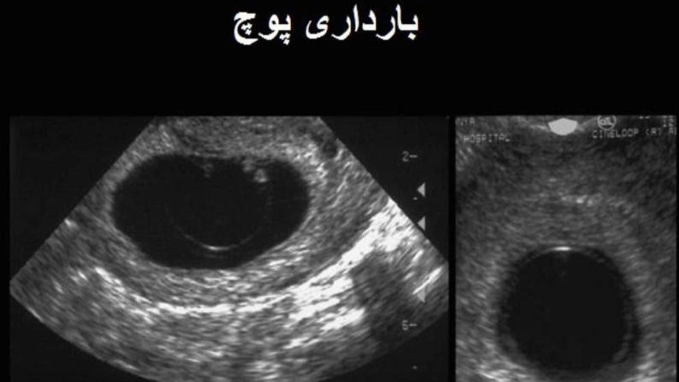 What are the symptoms of molar pregnancy?