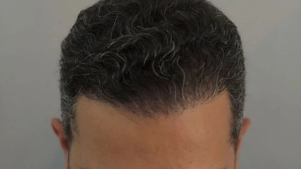 Rasht Royan Transplantation Center, specialized hair and eyebrow transplant services by micrograft method