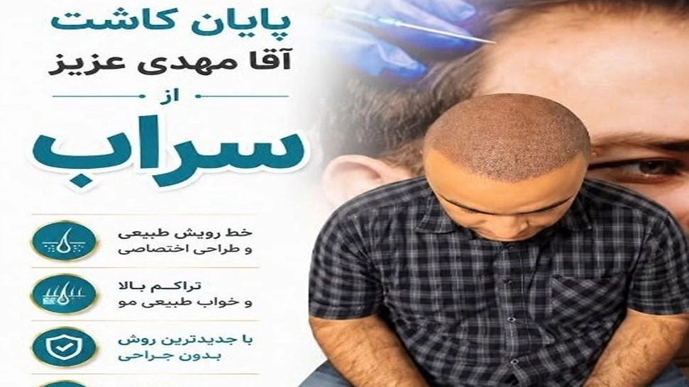 Cost of hair transplant in Tabriz with Rahimi clinic
