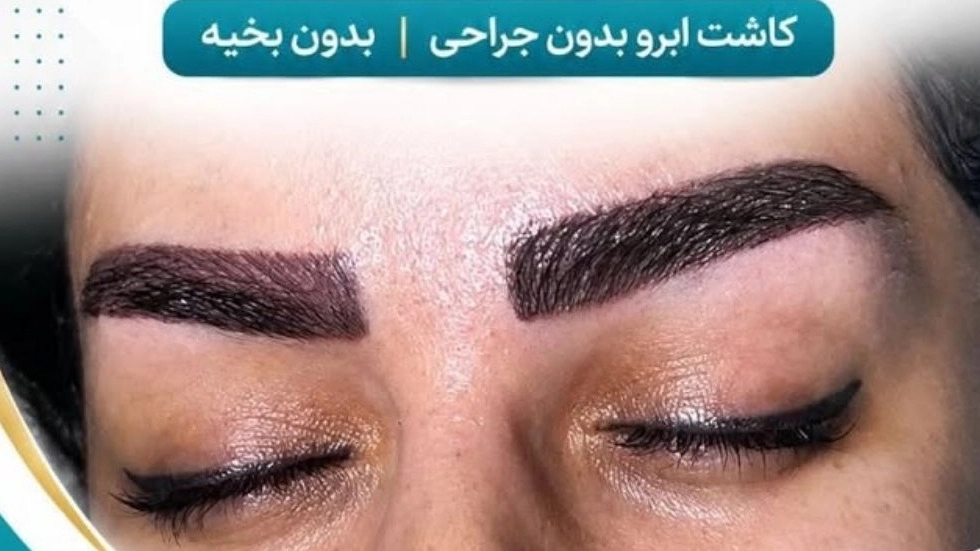 Eyebrow transplant services at a reasonable price in Tabriz