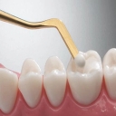 Performing nano-ceramic dental dental New Face One composite in Andisheh Shahriar