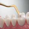 Performing nano-ceramic dental dental New Face One composite in Andisheh Shahriar