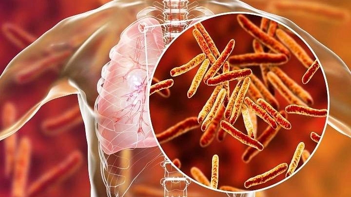 Tuberculosis