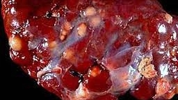 Caseous lymphadenitis disease