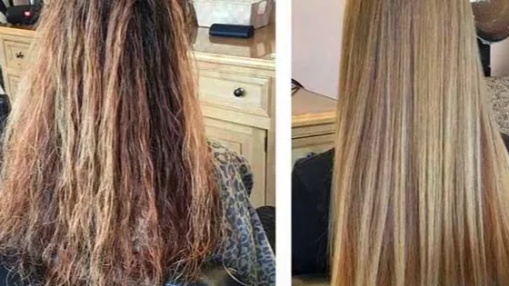 What is hair restoration + methods of hair restoration