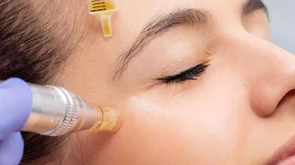 What is hair mesotherapy?