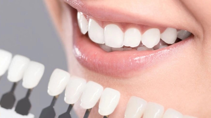 لمینت دندان چیست و چه کاربردی دارد؟