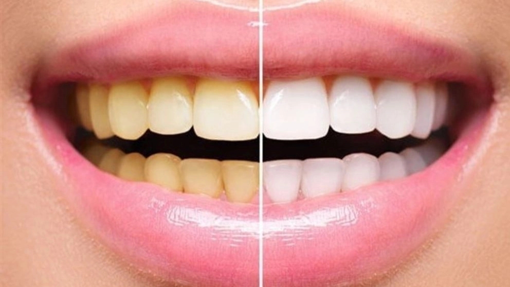 What is dental laminate and what is its use?