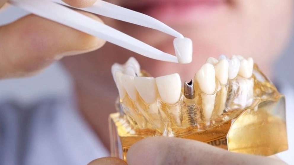 Introducing types of fixed and mobile dental prostheses