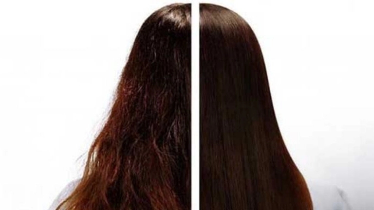 Hair restoration methods