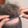 Iran Hair, specialized hair prosthesis center in Isfahan