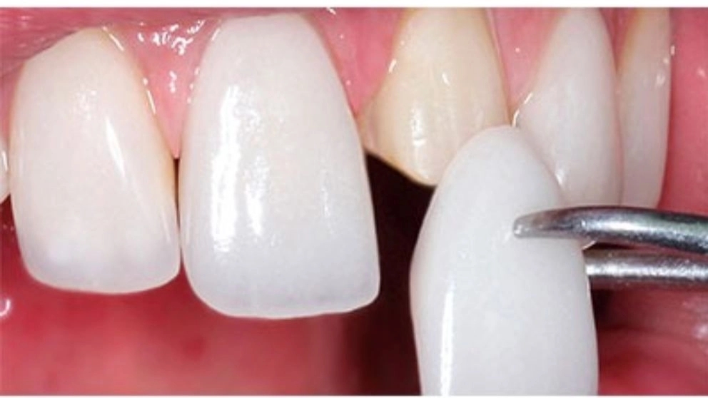 Dental cosmetic methods