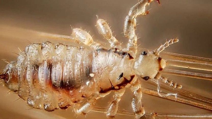 Definitive treatment of head lice in Tehran