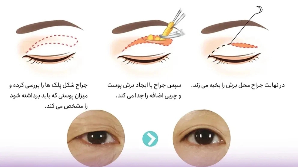 What is blepharoplasty?