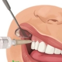 Hayan dental equipment, distribution of cartridge injection needles and gutta meta in Qom