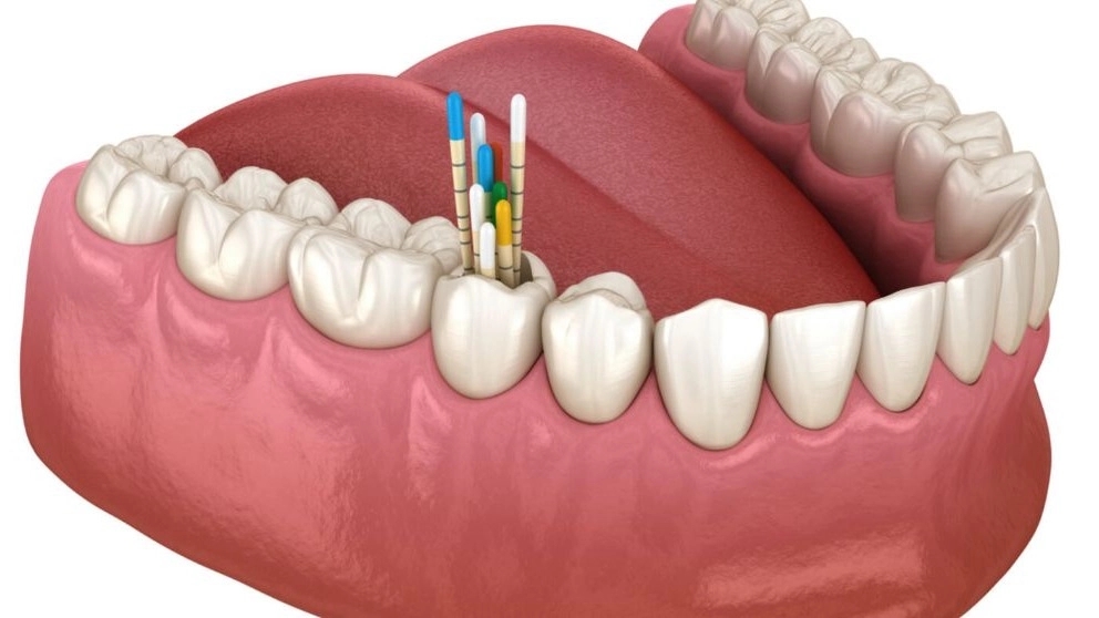 Benefits of gutta percha in dentistry