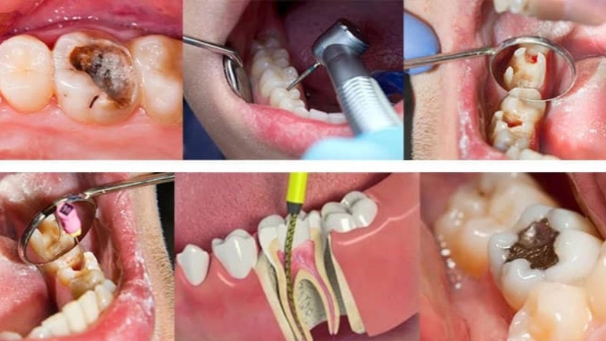 The difference between tooth root treatment and nerve extraction