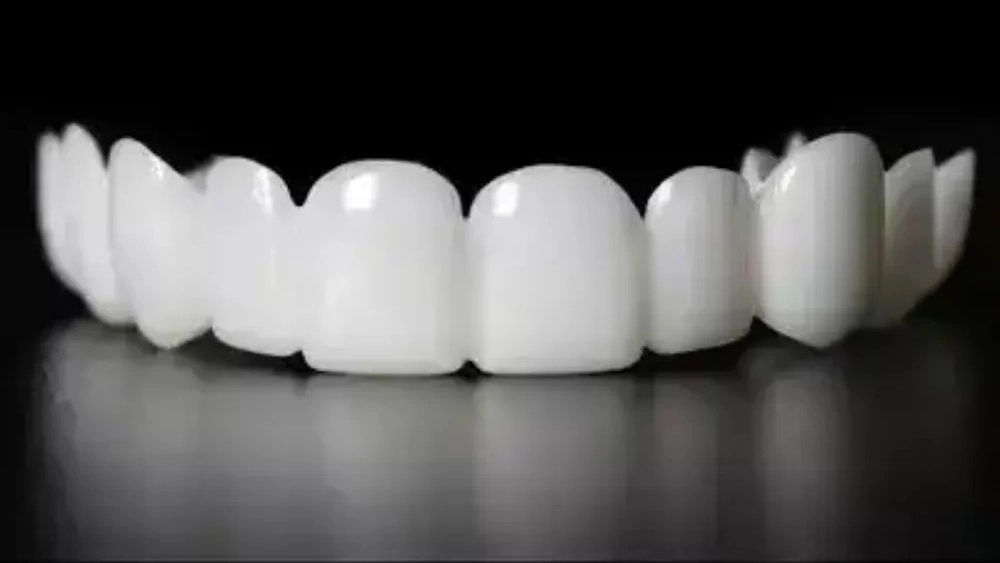 Immediate dental veneers