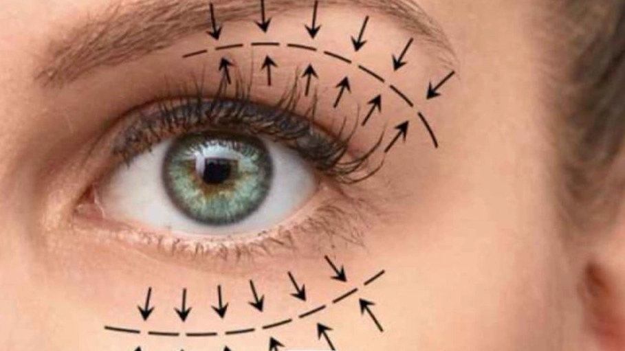 Blepharoplasty at Sagar Beauty Clinic in Sattar Khan, Shiraz