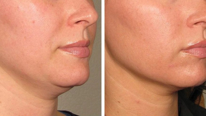 Sagar beauty clinic, mesotherapy in Shiraz