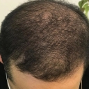 Hair transplantation, hair and eyebrows in Tehran