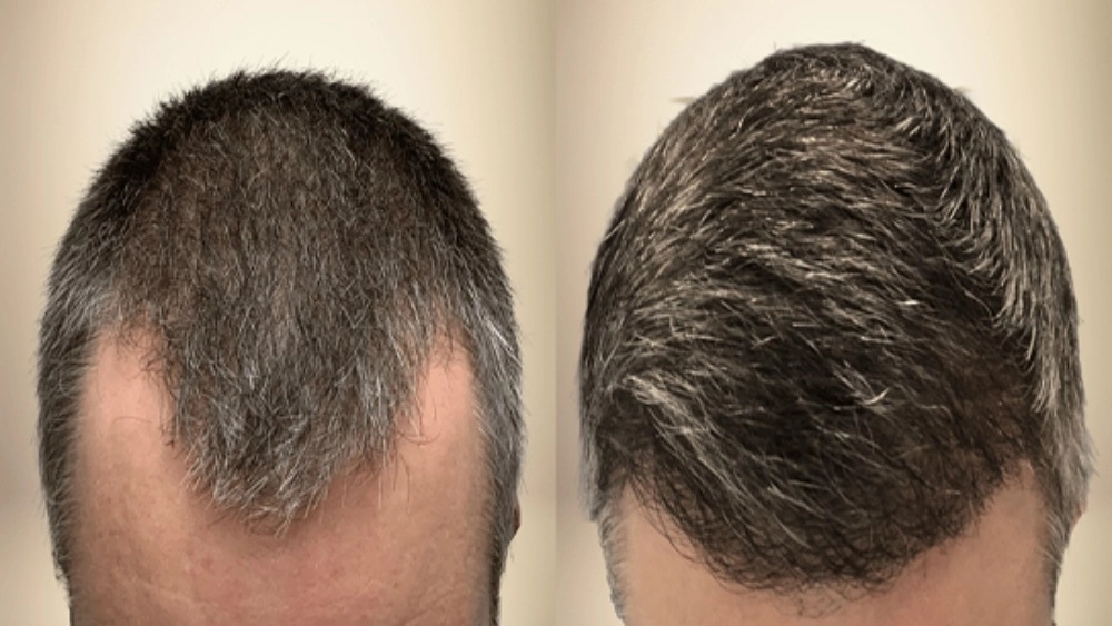 Hair transplantation, hair and eyebrows in Tehran