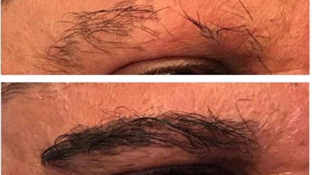 کاشت ابرو امین مومنی