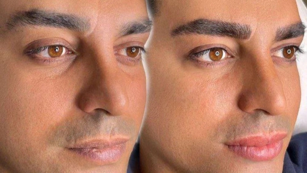 The Eyebrow Services of the King's World, Microbleeding Ben and Men's Lips Shid in Hamadan