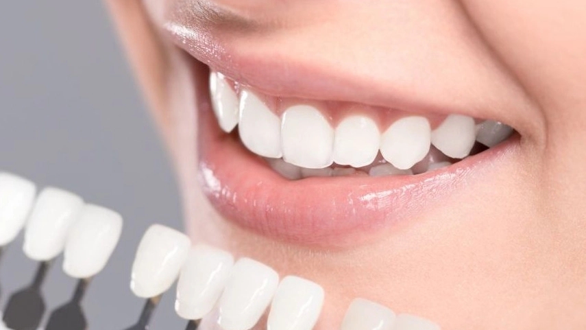 Karen Dental Clinic, Medical and Cosmetic Services of Composite Laminitis in Tehran