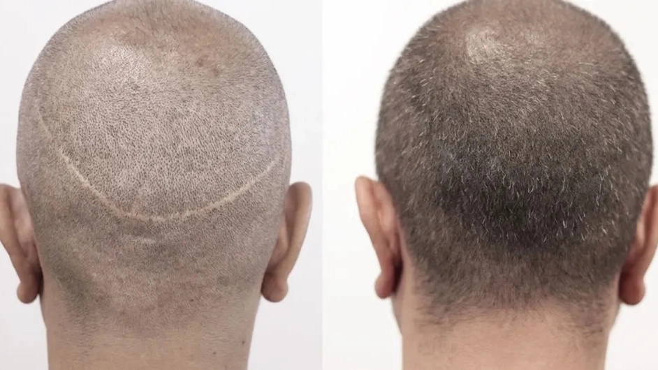 العيادة الرئيسية المتخصصة بزراعة الشعر والحواجب في كرمان