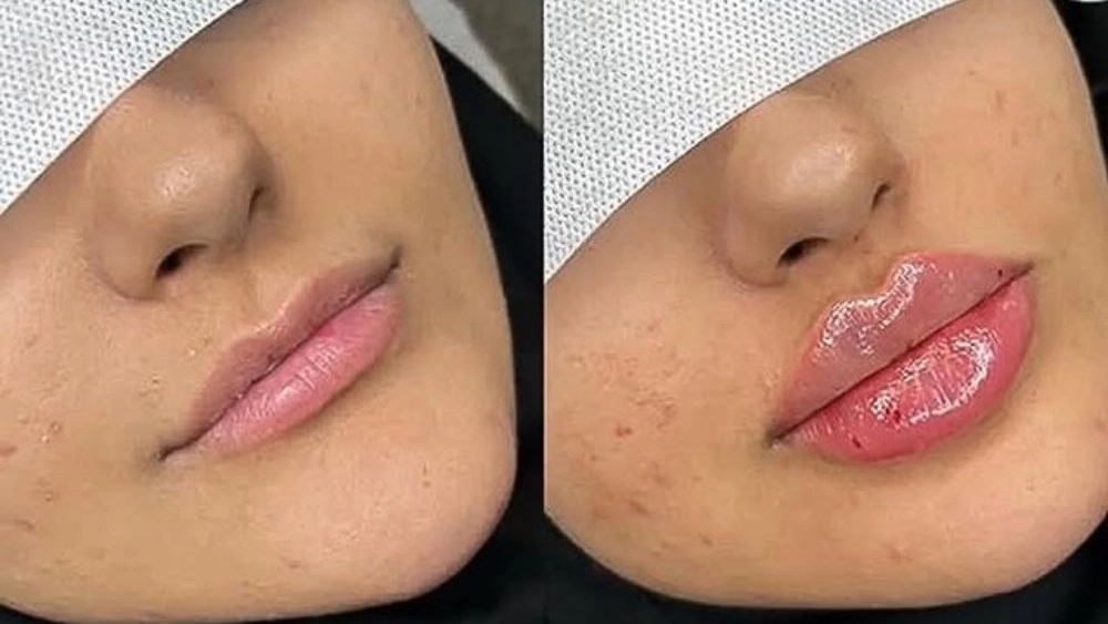 My Na Beauty Clinic, providing botox filler mesotherapy and PRP services in Kermanshah