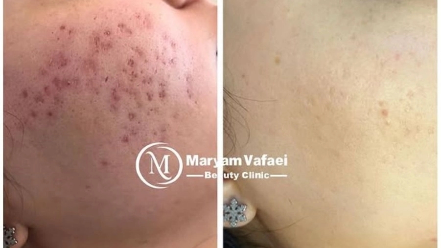 Vafai facial, acne and meso skin treatment services in Gachsaran