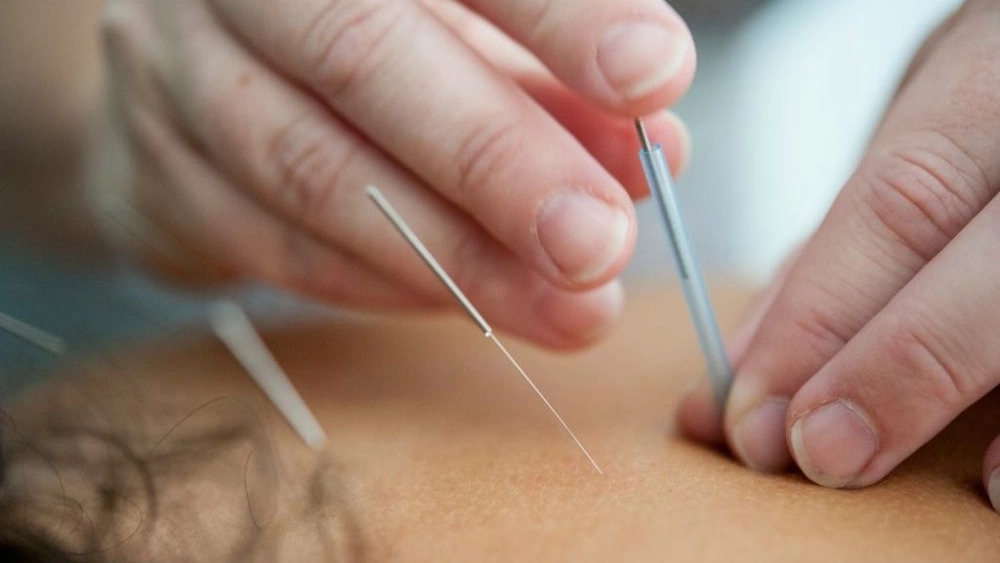 Dr. Shadman's acupuncture services, slimming with thread implantation in Tehran