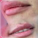 Moana beauty clinic, beauty services and botox lip fillers and rejuvenation in Sabzevar
