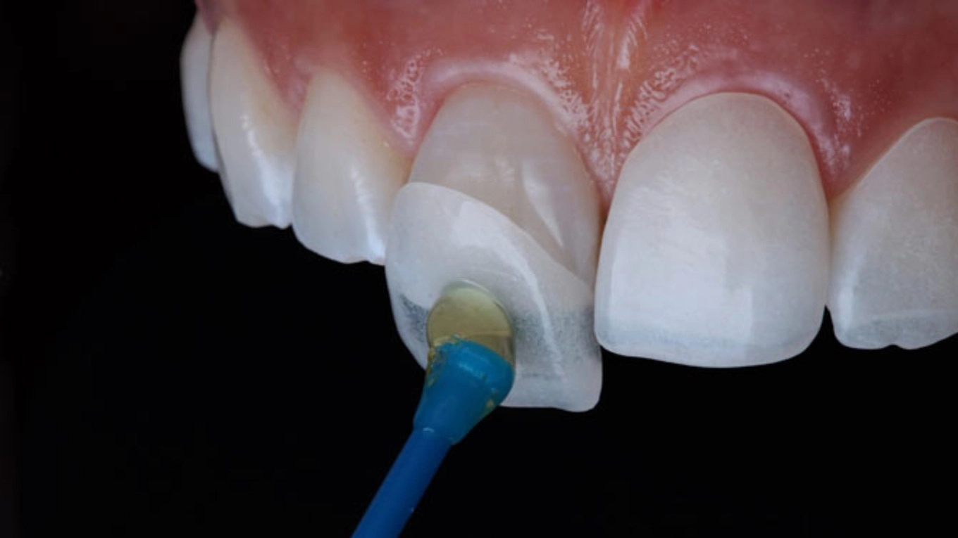 Dental nano ceramic composite
