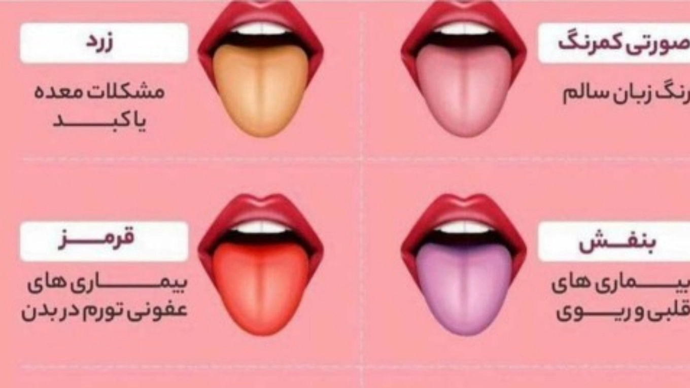 Diagnosis of fatty liver from the tongue