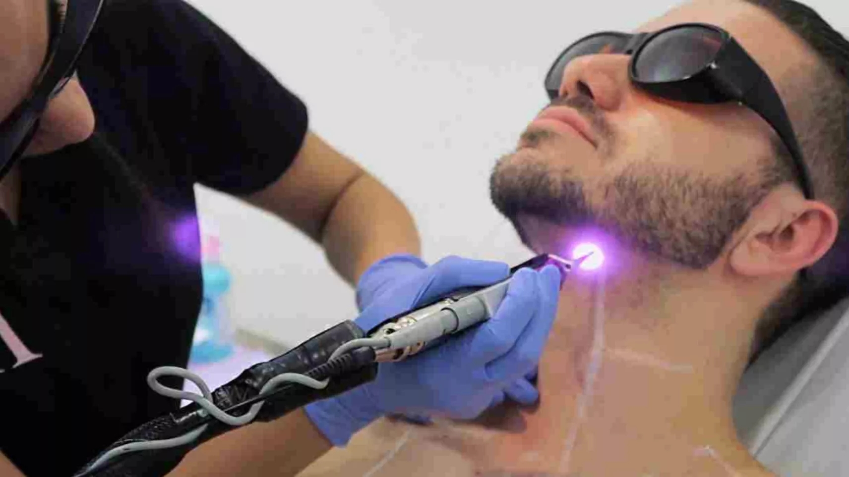 Can laser hair removal cause infertility?