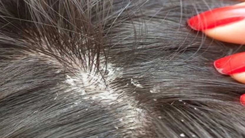 What is the cause of head lice?