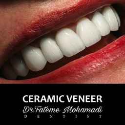 Dr. Fatemeh Mohammadi Dental Clinic, Laminate Implant in Isfahan