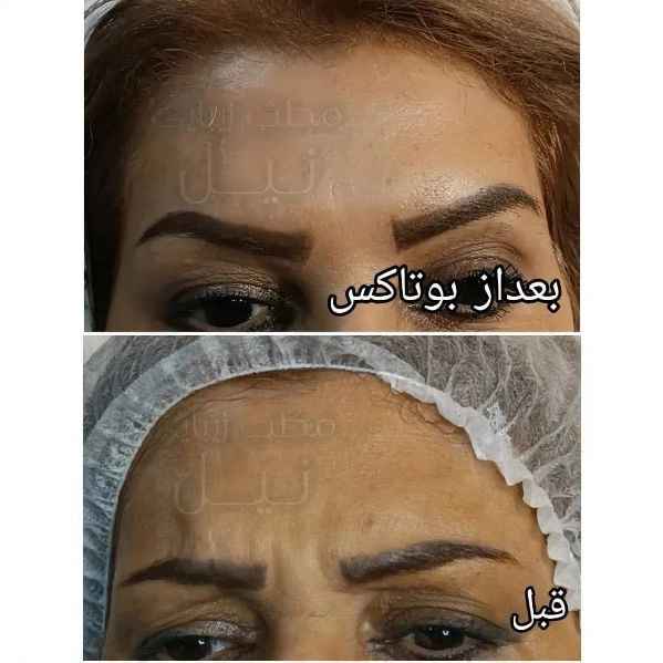Botox