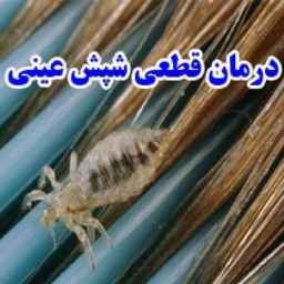 Definitive treatment of head lice in Tehran