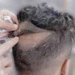Mustafa Hami hair prosthesis in Sari