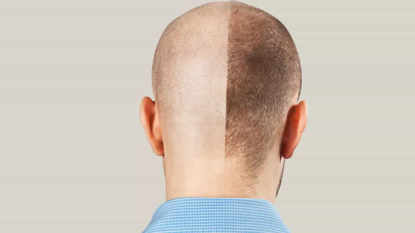 hair transplant
