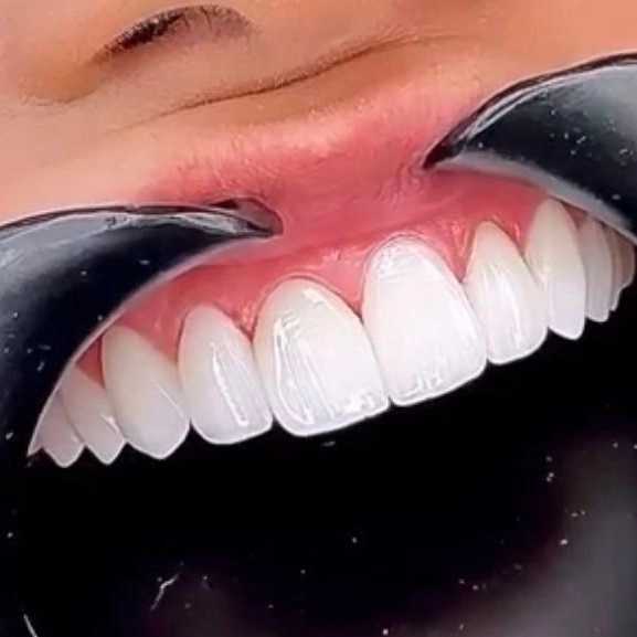 کامپوزیت نانو سرامیک دندان