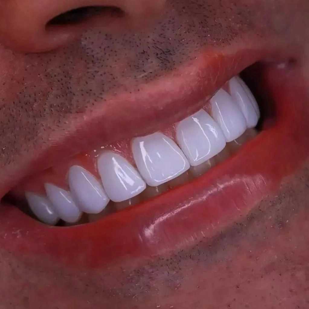کامپوزیت نانو سرامیک دندان