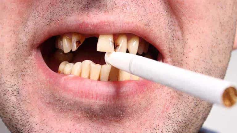 The harmful effects of smoking on teeth