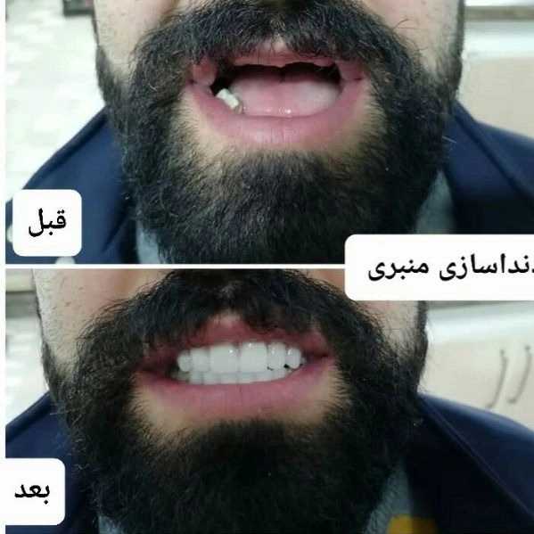 دندانسازی بیستون منبری