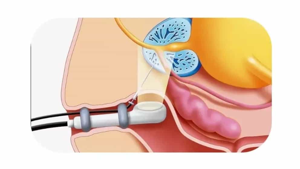 Transrektal ultrason